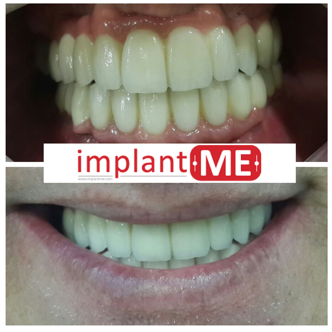 implantME