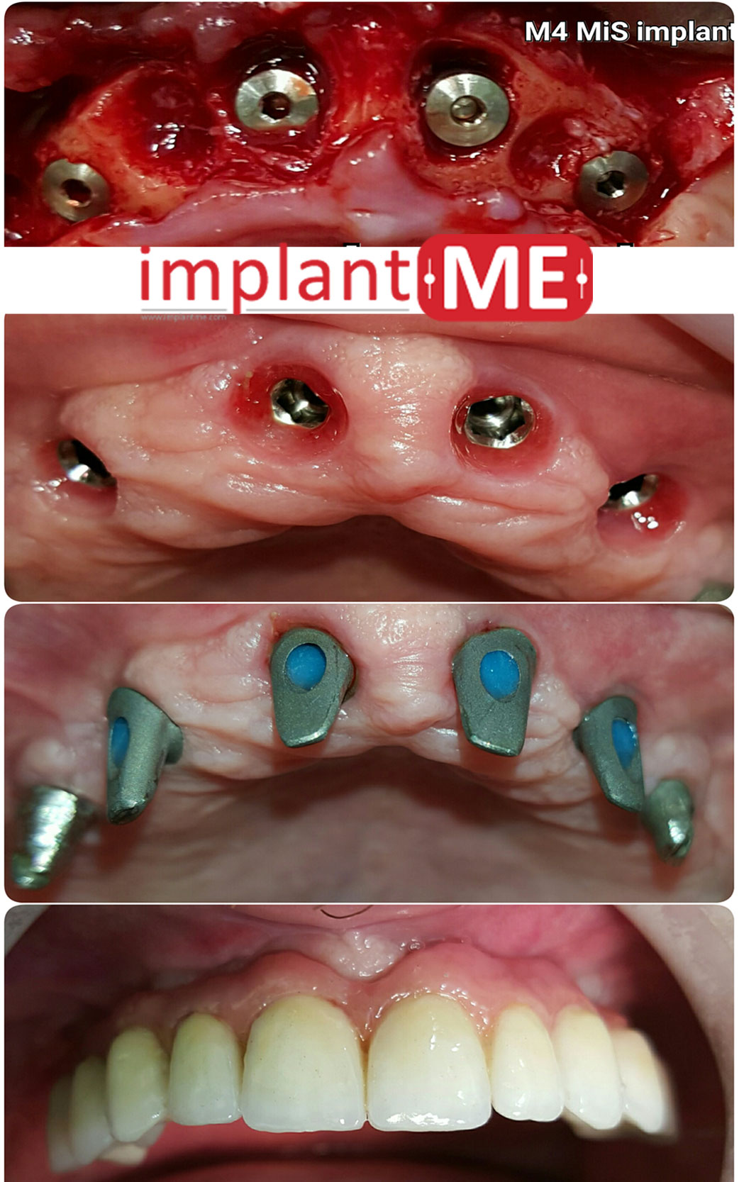 implantME